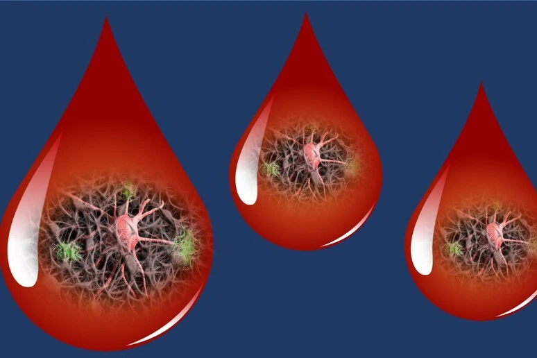 Alzheimer, verso la diagnosi da una goccia di sangue