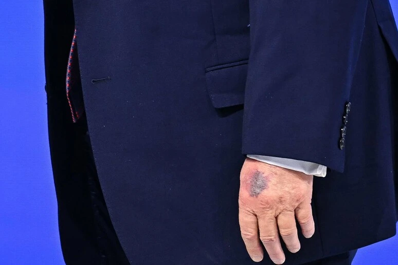 Trump minimizza il livido sulla sua mano: 'L'ho sbattuta contro un tavolo'