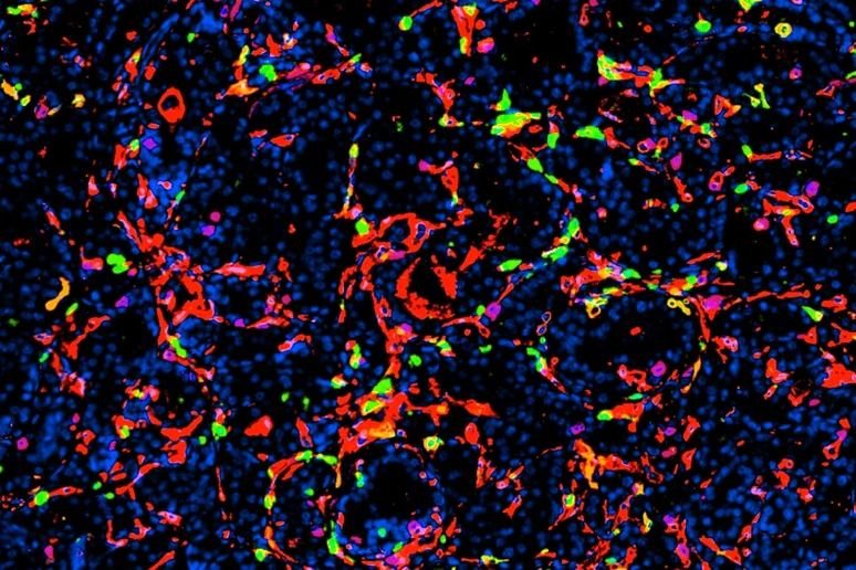 Nanoparticelle efficaci contro il tumore della prostata, uccidono le cellule