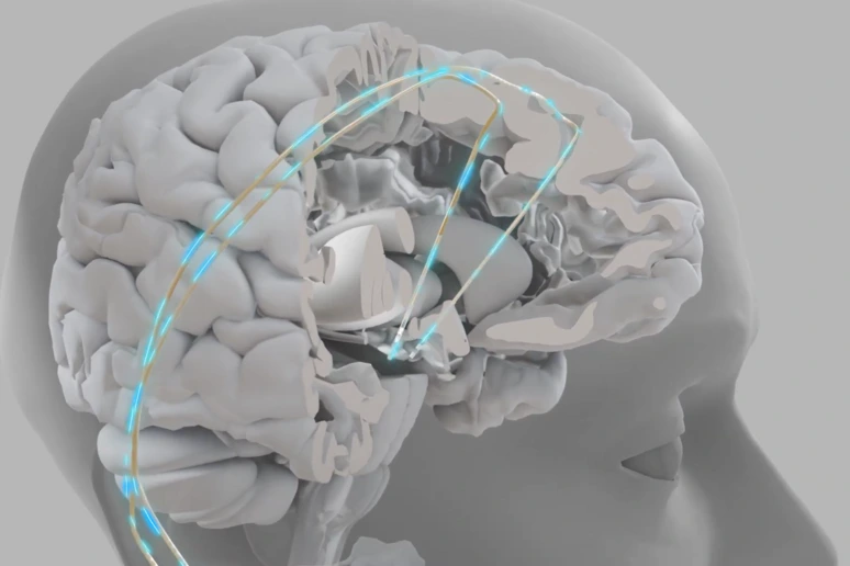Chip impiantabili più vicini, aiutano a parlare e a camminare   VIDEO